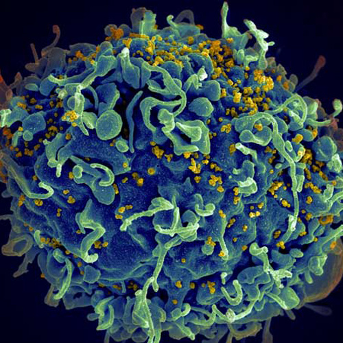 Photo of HIV infecting human cell