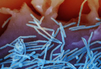 The surface of human lung epithelial cells shed RSV virions (colorized blue)