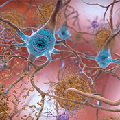 Beta-amyloid plaques and tau in the brain