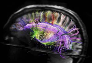 Scan of brain in black and white from the side, many small brightly colored fibers throughout