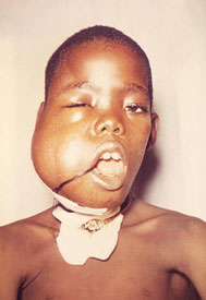 Boy child suffering from Burkitt's lymphoma has swollen face, tube inserted into throat