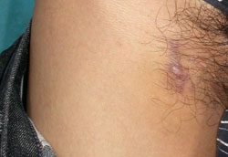 Close up of man's leg near groin area showing soft tissue sac for injecting drugs