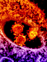 Microscopic image of MERS virus - orange balls surrounded by orange and purple swirl on black background