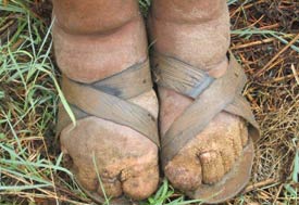 Close up of swollen, disfigured feet and toes in sandals due to podoconiosis