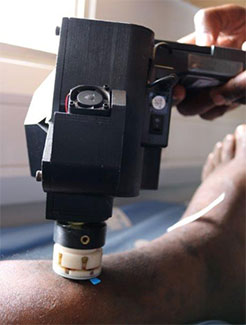 A smartphone confocal microscope held by a medical worker to a patient’s leg.