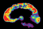 Colorful brain scan of brain with Alzheimer's disease on black background