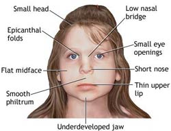 Diagram: face of young girl, full description below image