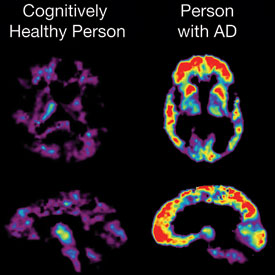 Brain scans show cognitively health brain next to brain of person with Alzheimer's disease