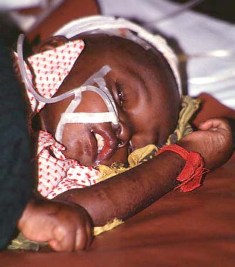 photo of a baby with malaria